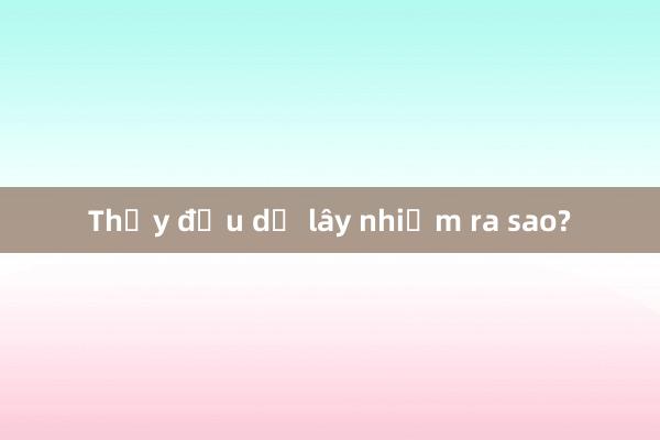 Thủy đậu dễ lây nhiễm ra sao?